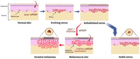 Intradermal Nevus Symptoms Causes And Treatments