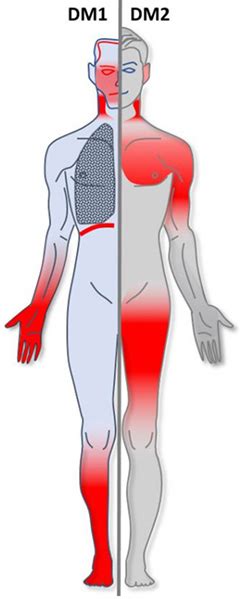 Myotonic dystrophy - Wikiwand