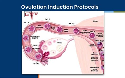 Ovulation Induction Protocols - Orkid Medilife Hospital