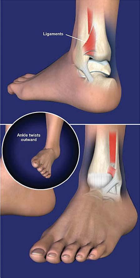 High Ankle Sprain (Syndesmosis Ligament Injury) | Central Coast ...