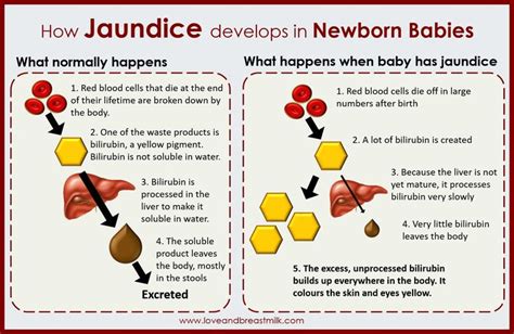 How jaundice develops in newborn babies. It all makes so much sense ...