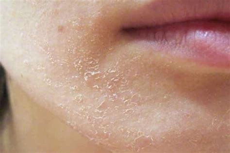 Dry Patches On Face Flaky Peeling Red White Pictures Causes Get