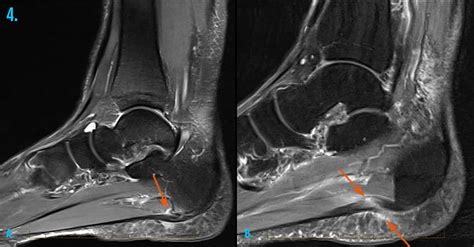 Medial Ankle Ligaments Mri