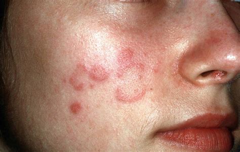 Polymorphic Light Eruption Cutaneous Lupus Erythematosus ...