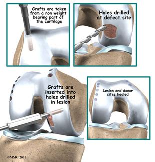 Articular Cartilage Transplant | Knee Doctor near Seattle WA