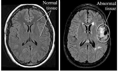 Normal Vs Abnormal Brain MRI