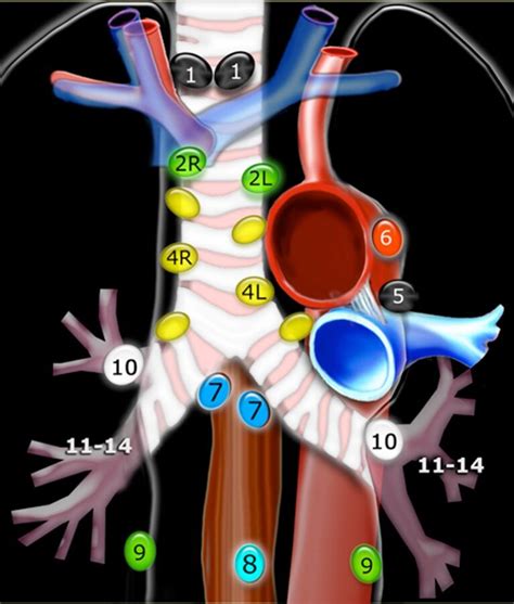 Lymph node stations in the mediastinum. Lymph node stations 3a and b ...