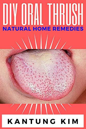 DIY Oral Thrush Natural Home Remedies: The Effective Step By Step Guide ...