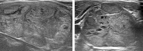 Diagnosis of Thyroid Nodules from Medical Ultrasound Images with Deep ...