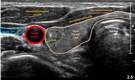 Thyroid Cancer Now Diagnosed with AI Photoacoustic/Ultrasound Imaging ...