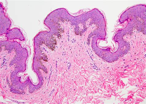 Epidermal Nevus Histology