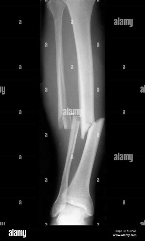 An x-ray showing a fracture of the tibia and fibula of the lower leg ...