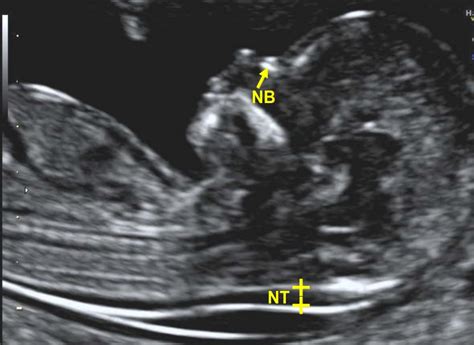 Opinions on nuchal translucency