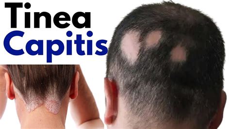 Tinea Capitis (scalp Ringworm): Causes, Symptoms, And, 43% OFF