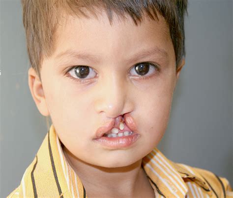 Cleft Lip Surgery, Cleft Lip Surgery Cost, Cosmetic Clinic | Medlife