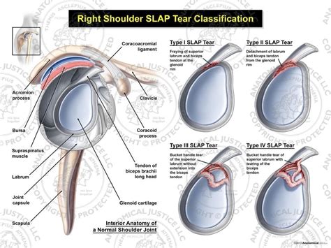 [DIAGRAM] Slap Tear Diagram - MYDIAGRAM.ONLINE