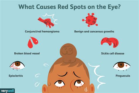 Red Spot on Eye