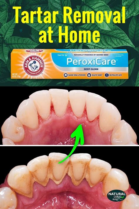 Dental Hygiene: Learn how to remove tartar from teeth without dentist ...