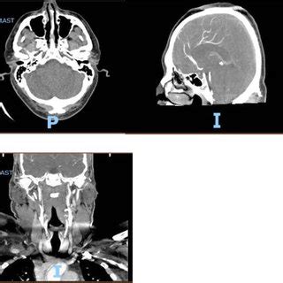 CT angiogram with IV contrast head and neck with patent circulation. A ...