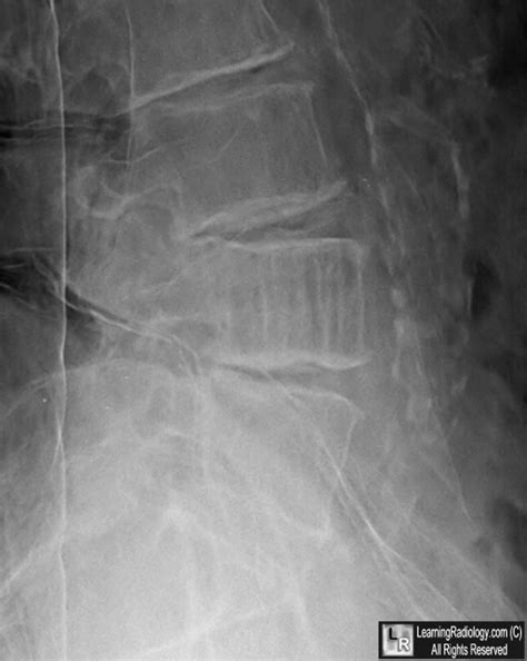 LearningRadiology - Hemangioma, spine, vertebra