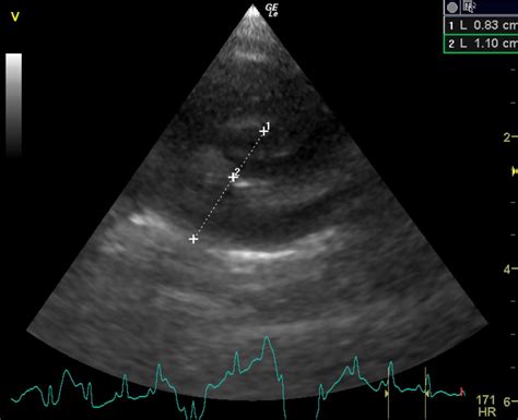 Myxomatous stage B1 mitral valve disease with moderate mitral ...