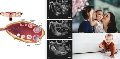 Ovulation Induction Treatment in Indore - AIIM