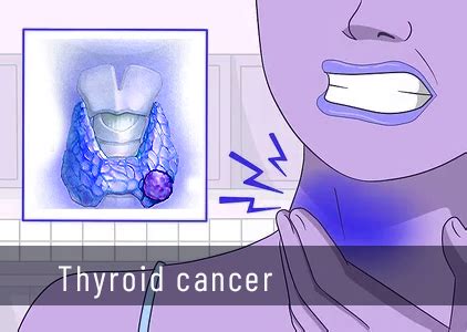 Thyroid cancer - Symptoms and causes | what Survival Rates? - All about ...