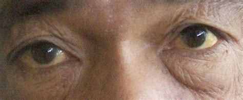 Yellow Eyes Causes And Treatment - Infoupdate.org