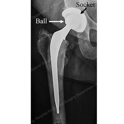 dislocation following total hip replacement causes and cures - meghan ...