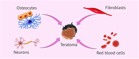 Ovarian Teratoma - Can It Contain Teeth, Hair & Other Organs?