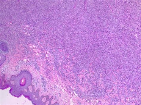 Dermatofibroma Histology