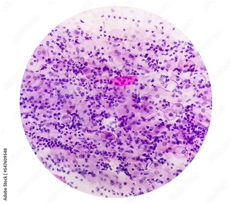 Paps smear. Microscopic examination of pap smear showing inflammatory ...