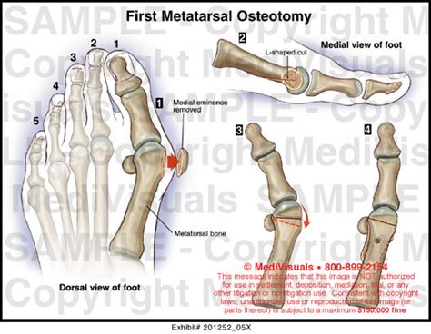 First Metatarsal Osteotomy Medical Exhibit Medivisuals