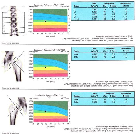 20 Best Bone Density Test Results Chart Chart Gallery | Images and ...