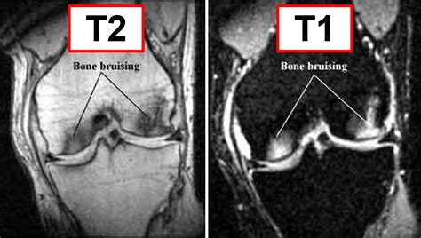 Bone Bruise - Causes, Symptoms, Diagnosis, Treatment & Healing Time