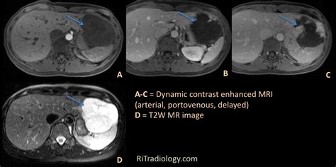 RiT radiology: Hepatic Hemangioma: MR Findings