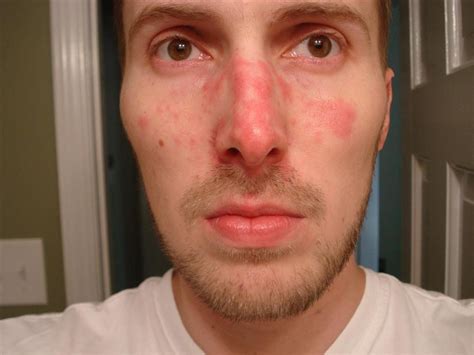 Red Dry Skin Flaking At Steven Perez Blog