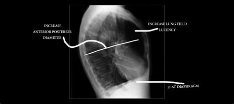 Emphysema Chest X Ray