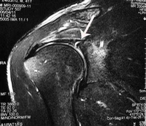 SLAP (Superior Labrum Anterior Posterior) Tear | Dr HC Chang