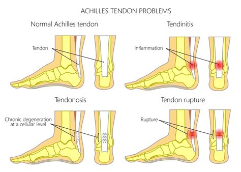 Exercises For Extensor Tendonitis In Foot - Exercise Poster