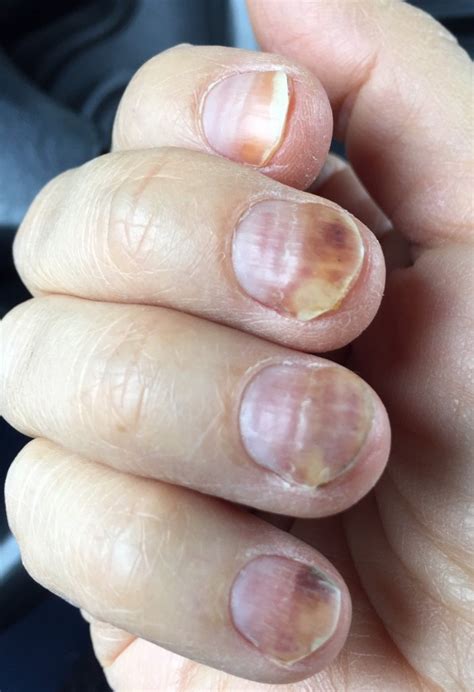 I Didn’t Expect THAT: Chemo Nails – Frantic Shanti