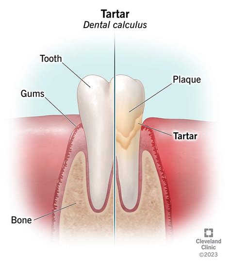 Tartar on Teeth (Dental Calculus): Causes & Removal