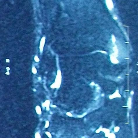 a-b: (a) Initial MRI after trauma demonstrated bone bruise at medial ...