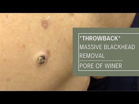 *THROWBACK* Massive Blackhead Removal POW!| Dr. Derm - YouTube ...