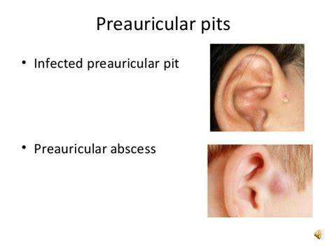 Branchial Remnants and Branchial Cyst