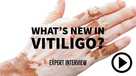 What’s new in vitiligo treatment?