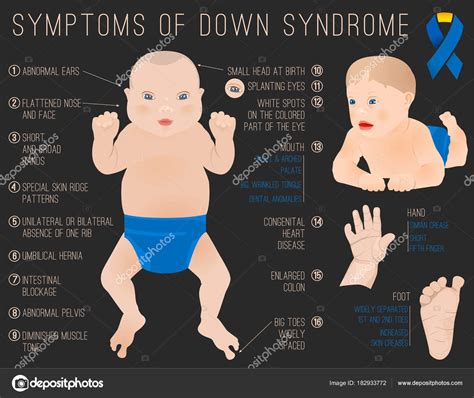 Down Syndrome Symptoms