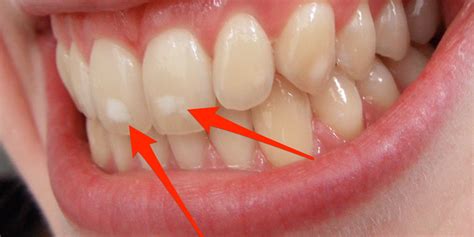 White spots on teeth are related to childhood health - Business Insider