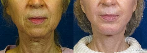 Laser Facelift – Murrieta Facial Plastic Surgery