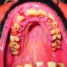 (PDF) Amlodipine Induced Gingival Hyperplasia – a Case Report and Review